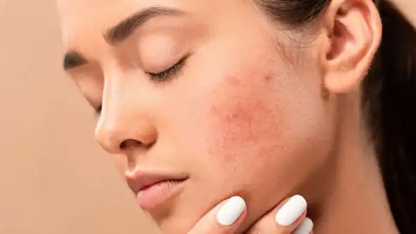 کوکتل درمان منافذ باز و ضد آکنه فیوژن ACN