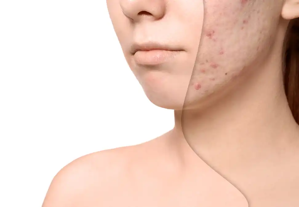 beauty land neuramis co acne scar 220529 220616