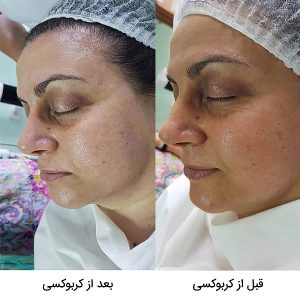 ژل کربوکسی ریب اسکین